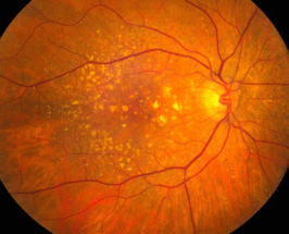 Macular-1