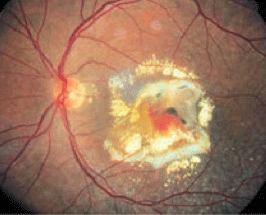 Macular-2