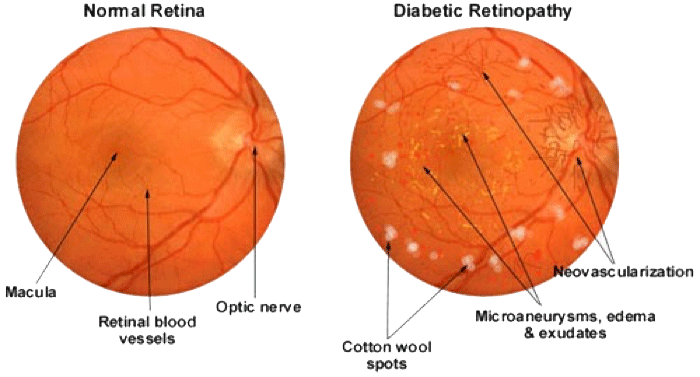 Retina Raleigh, Diabetic Retinopathy Raleigh